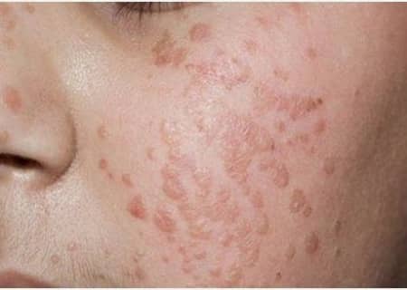 Molluscum extraction treatment